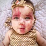 Baby Called “Hideous” and “Defective” for Red Birthmark, But Wait Until You See This Adorable Child Now